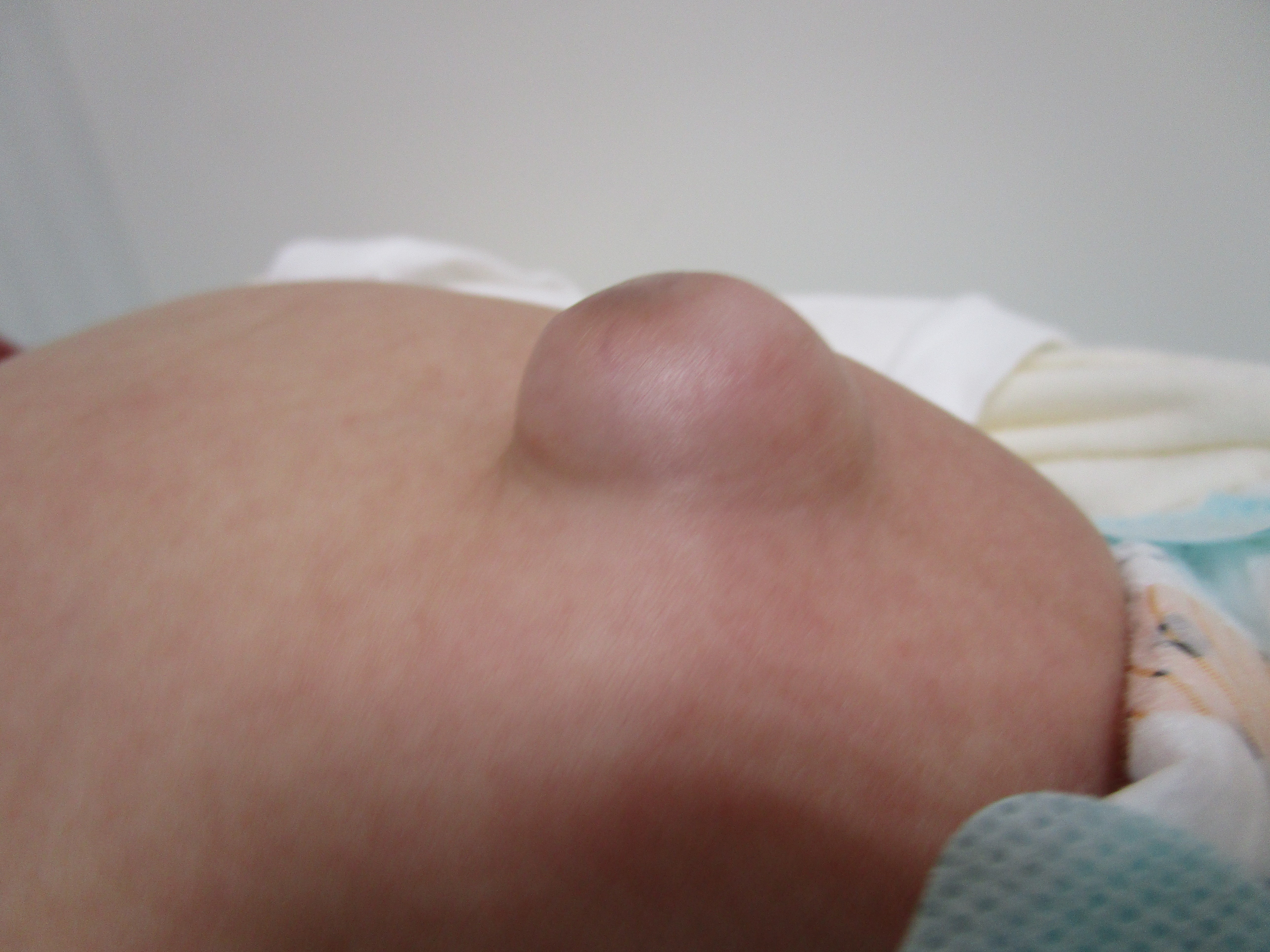 治療開始前の臍ヘルニアです 治療開始前の臍ヘルニアです