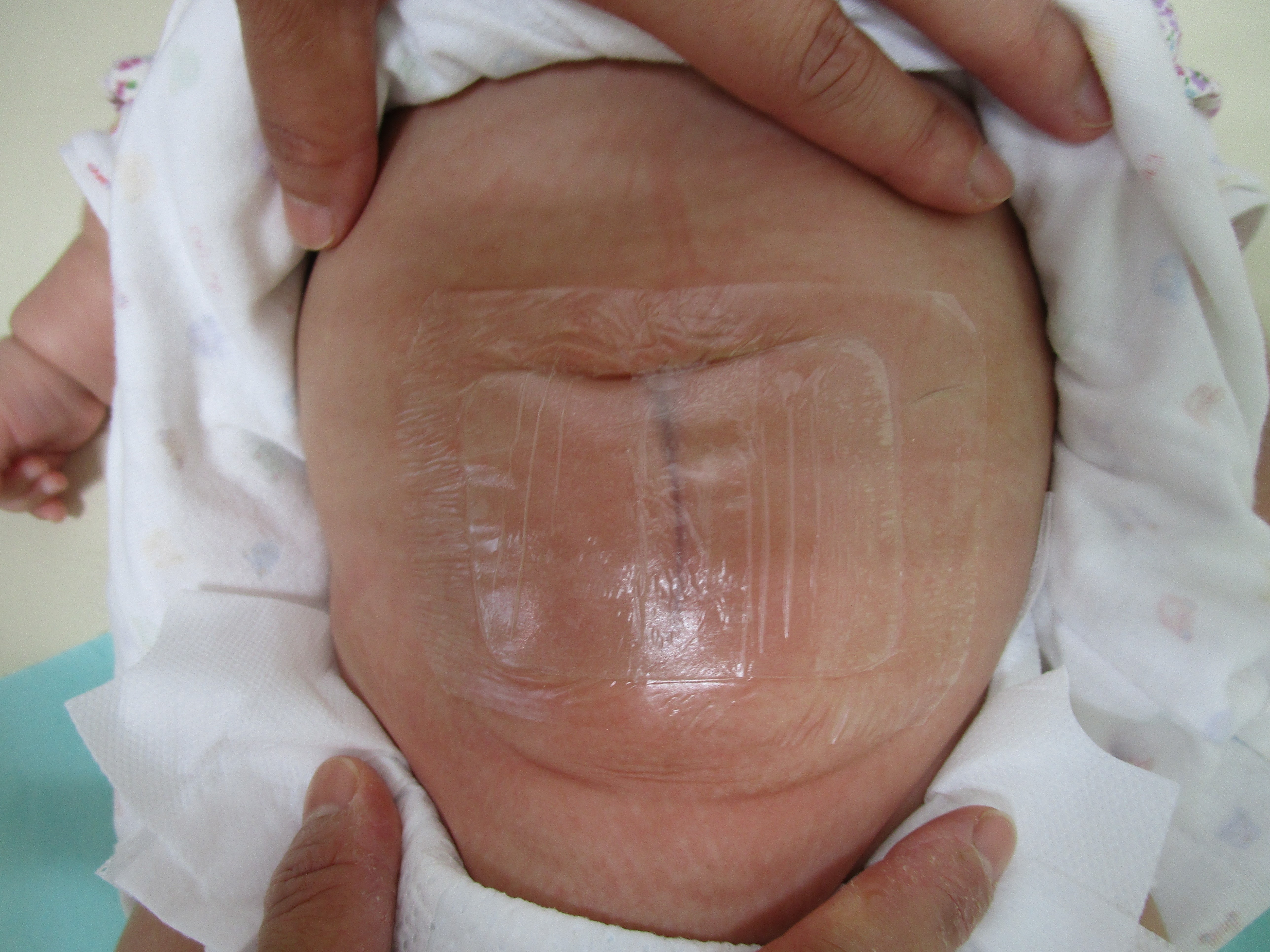 綿球と透明の防水テープで固定します 綿球と透明の防水テープで固定します